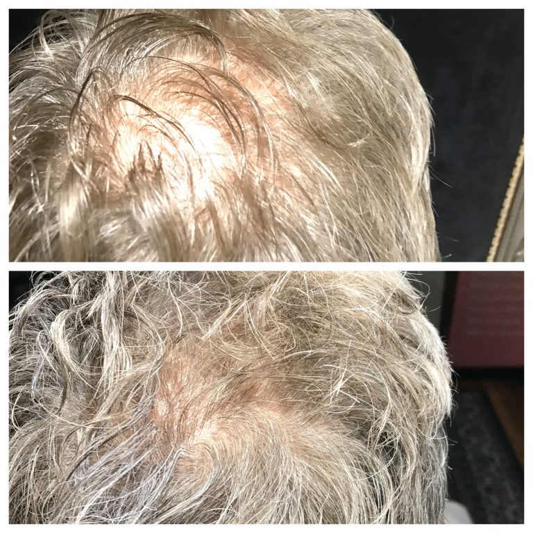 PRP scalp hair restoration