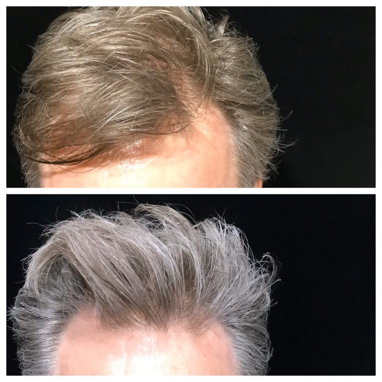 PRP Therapy Hair Loss Natural Hair Restoration Platelet Rich Plasma Therapy  Austin Tx