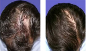 Hair Restoration, PRP is an all-natural autologous medical procedure performed in physicians offices for scalp, skin, and hair stimulation.