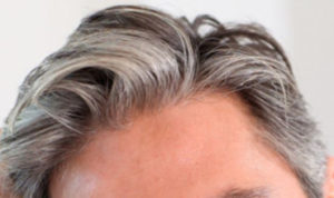 Platelet Rich Plasma Therapy in Hair Restoration in Austin, Texas