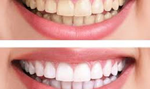 teeth_whitening_austin_2
