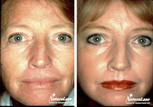 Erbium fractional laser before and after treatment