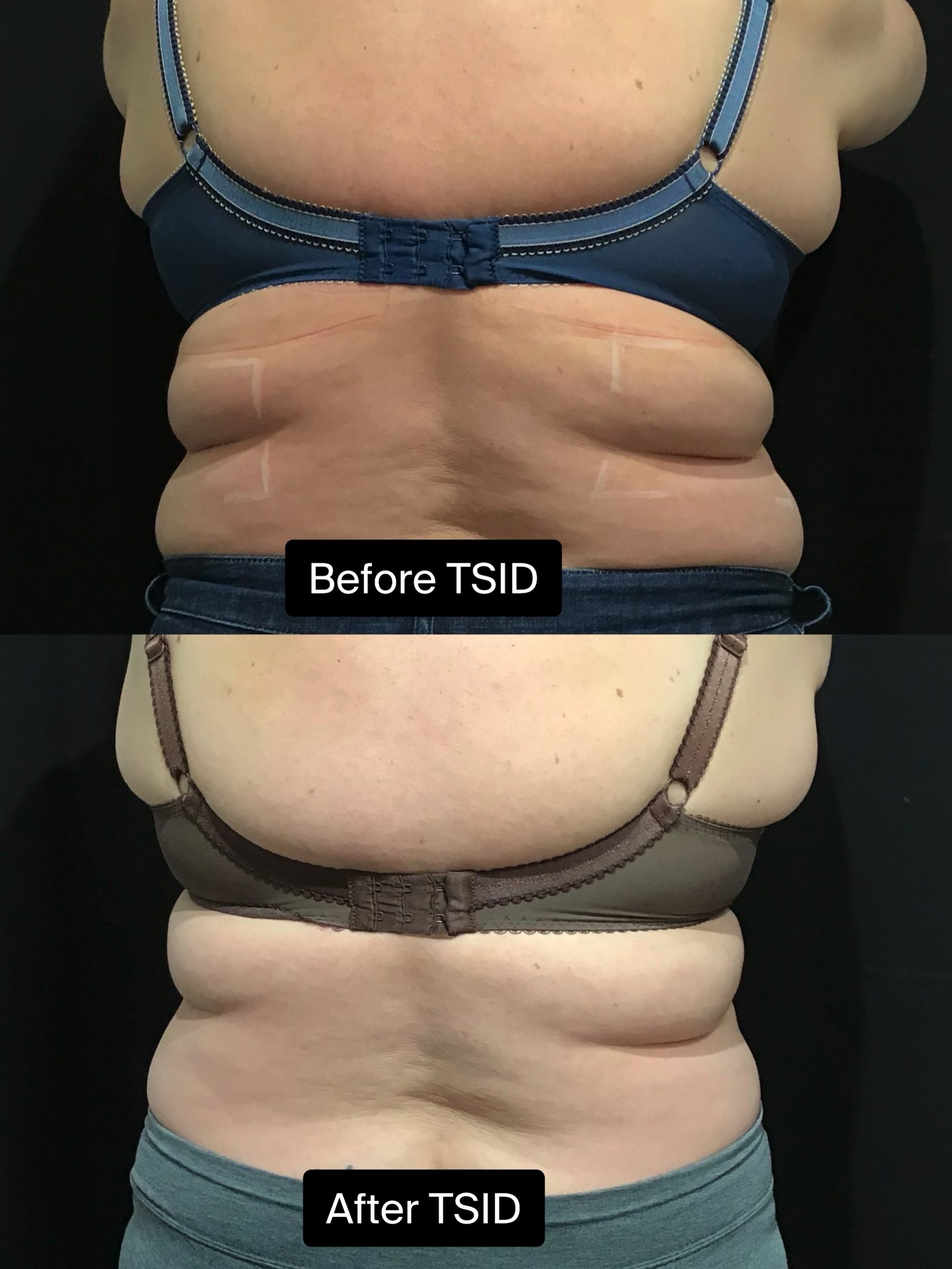 Trusculpt iD to reduce double-chin, bra fat, belly, thighs, knees, cankles:  Apex Dermatology: Skin Care Specialists