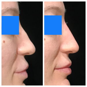 Dermal filler to the nose and lips