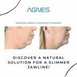 Agnes RF double chin reduction