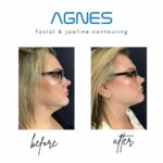 Agnes RF saggy jawline tightening