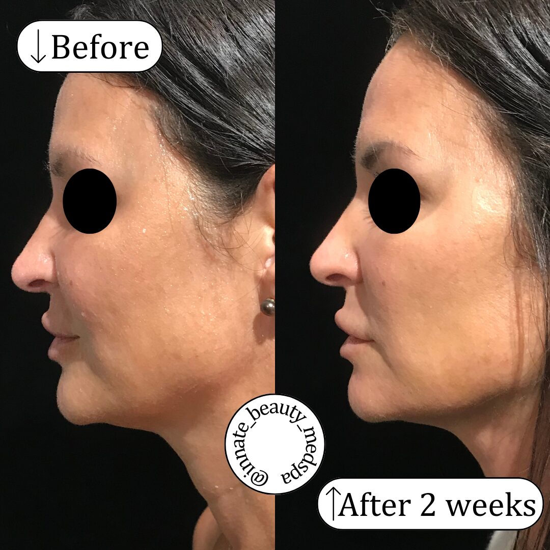 Agnes RF to jawline and nasolabial folds 44 year old