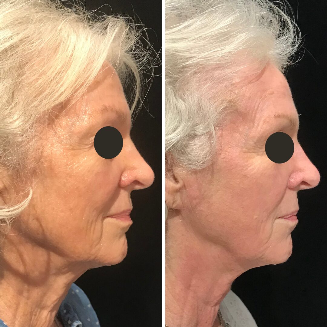 Agnes RF to jawline and nasolabial folds 75 year old