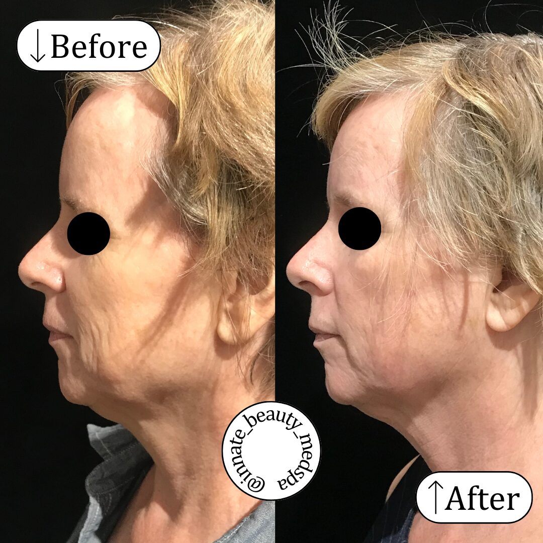 Agnes RF to jawline and nasolabial folds 58 year old, 4 weeks after