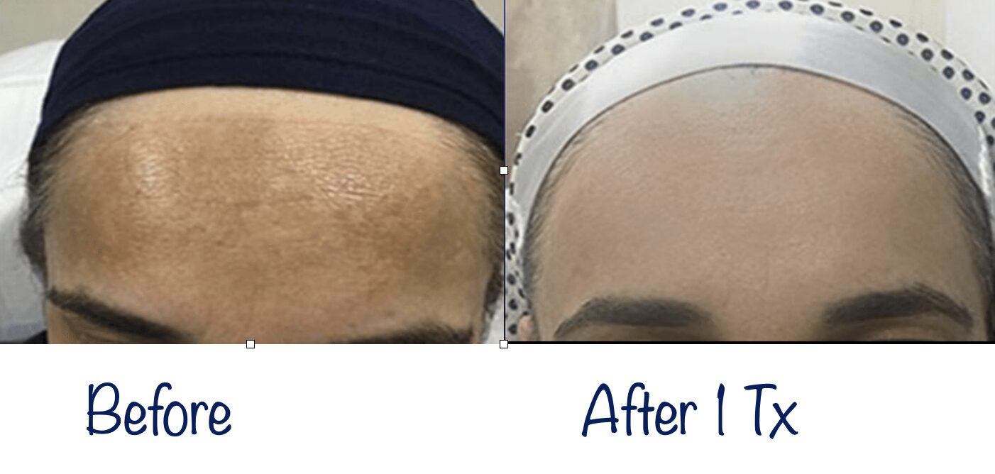 Nouvaderm laser for pigmentation